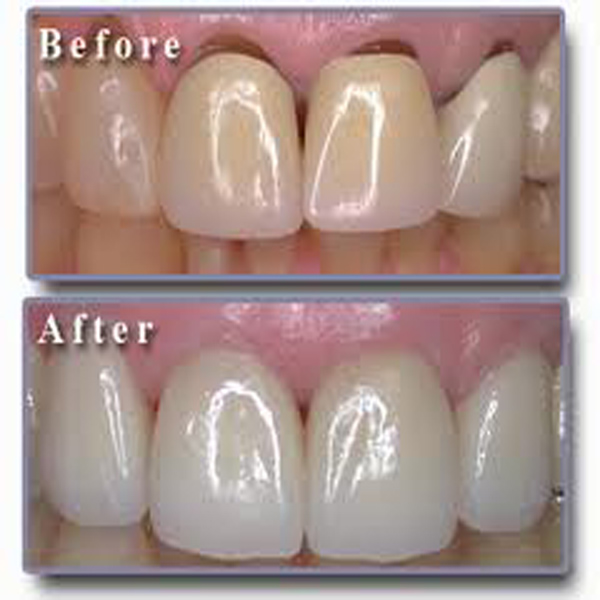  Teeth whitening